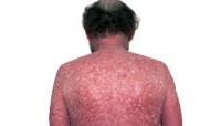 Erythrodermic psoriasis