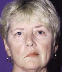 Facial asymmetry