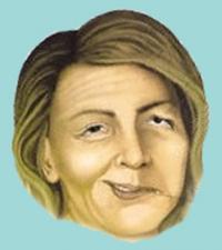 Facial paralysis