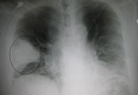 Filled alveoli