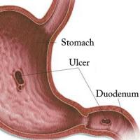Gastric ulcer