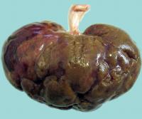 Glomerulonephritis