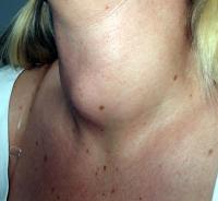 Goiter