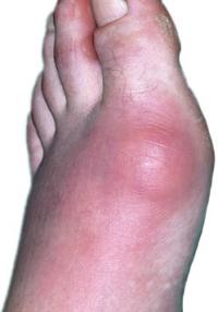 Gout