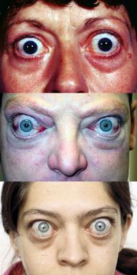 Graves disease