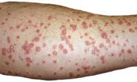 Guttate psoriasis