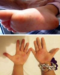 Hand-foot-mouth symptoms