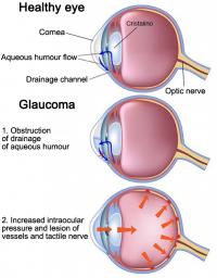 Healthy eye and glaucoma