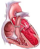 Heart failure