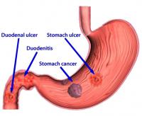 Helicobacter pylori diseases