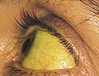 Hepatitis A
