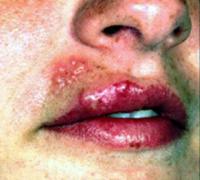 Herpes labialis