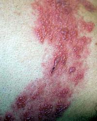 Herpes zoster