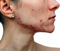 Hidradenitis suppurativa