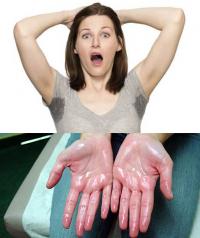 Hyperhidrosis