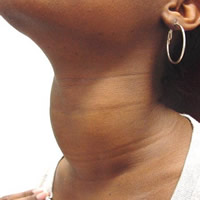 Hypothyroidism