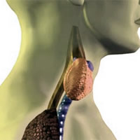 Hypothyroidism
