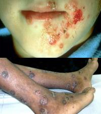 Impetigo