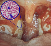 Infectious mononucleosis