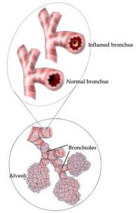 Inflamed bronchus