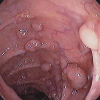 Intestinal polyps