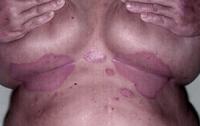 Inverted psoriasis