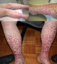 ITP symptoms