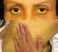 Jaundice