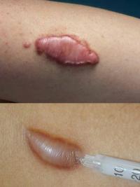 Keloid and hypertrophic scar