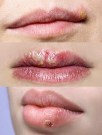Labial herpes