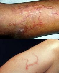 Larva migrans symptoms