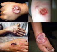 Leishmaniasis