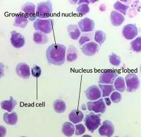 Leukemic cells under microscope