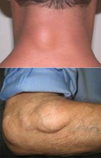 Lipoma on neck and arm