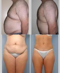 Liposuction results