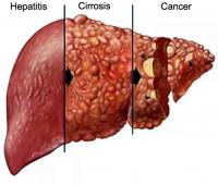 Liver diseases