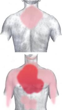 Locations of infarction pain