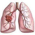 Lung cancer