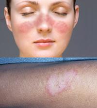 Lupus erythematosus