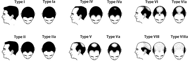 Male patterns of hair loss