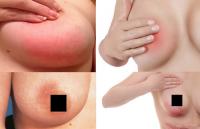 Mastitis