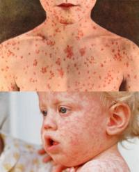 Measles symptoms