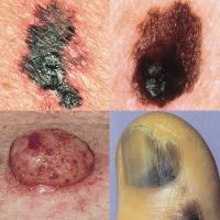 Melanoma