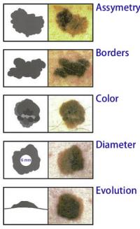 Melanoma symptoms