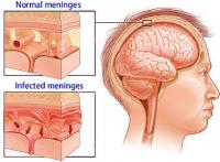Meningitis