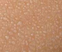 Miliaria crystalline