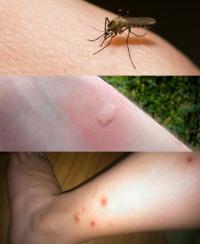 Mosquito bites