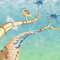 Multiple sclerosis