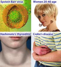 Multiple sclerosis risk factors
