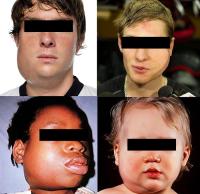 Mumps